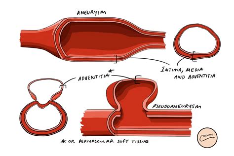 lv aneurysm vs pseudoaneurysm